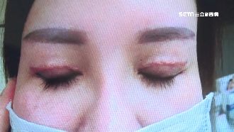 她去割雙眼皮　竟變「紅蜈蚣」掛臉上