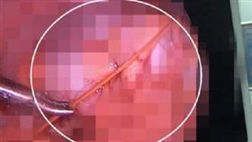 睡竹蓆出意外！6公分竹刺戳入女童腹
（圖／翻攝自微博）