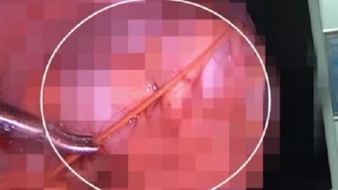 睡竹蓆出意外！6公分竹刺戳入女童腹