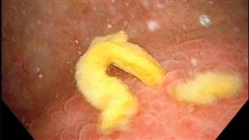 美國,阿嬤,糞尿液。(圖/翻攝自The New England Journal of Medicine)