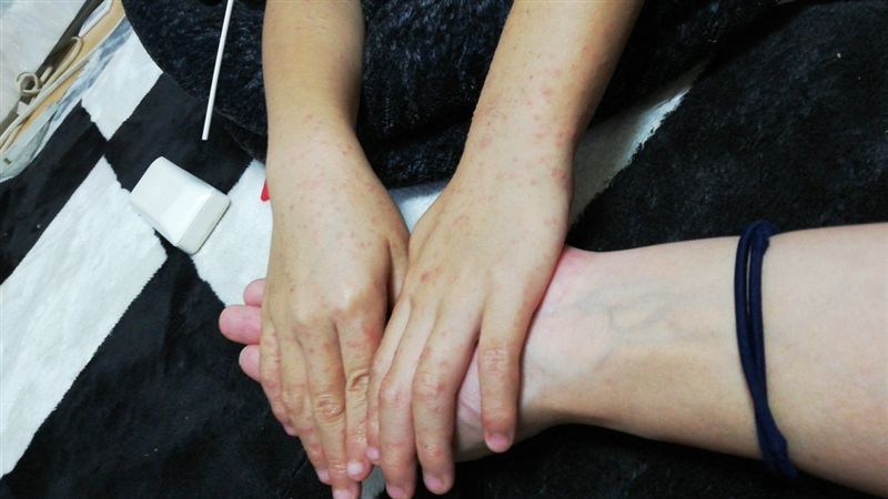東京手足口病超標　幼童手腳長滿泡疹