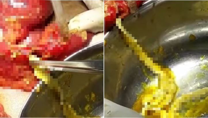 他胃痛就醫…肚內竟有180公分絛蟲