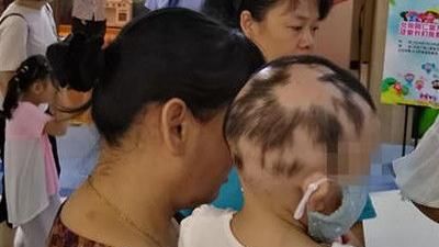 1個月頭髮掉光　1歲女童慘患鬼剃頭
