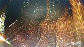 結腸黑變病（圖／翻攝自微博）