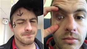 你洗澡時會拔下隱形眼鏡嗎？英國一名男子因為長期習慣帶著隱形眼鏡洗澡，眼球居然遭到寄生蟲入侵，感染了「棘阿米巴角膜炎（Acanthamoeba keratitis）」，現在生病的右眼已經失明，只能靠角膜移植才能恢復視力。（圖／翻攝自鏡報）