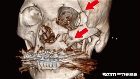64歲患者呂小姐經電腦斷層掃描後，箭頭處可見多處粉碎性骨折。（圖／馬偕醫院提供）