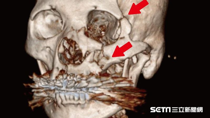 恐怖！鐵架「插臉」險瞎　全因它害的