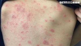 腸病毒,疹子,楊為傑,皮疹,重症
圖／楊為傑醫師授權使用