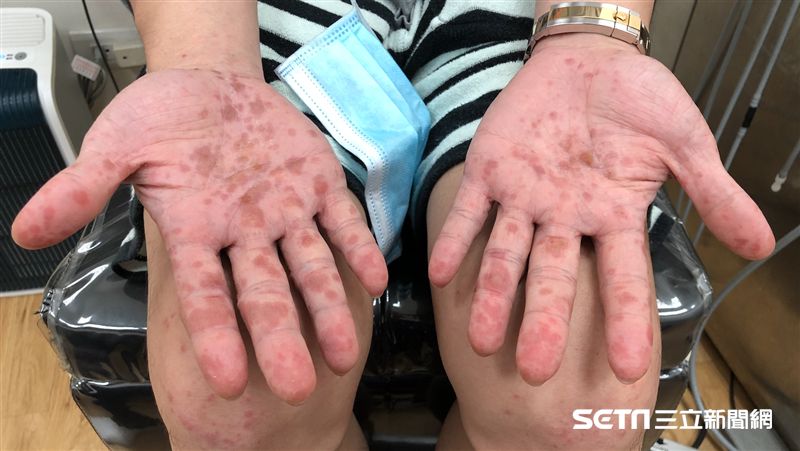 手腳冒紅疹、水泡　大人也會得這種病