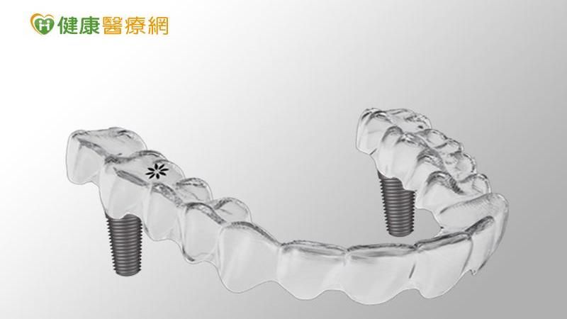 全口咬合重建　植牙隱形牙套新趨趨