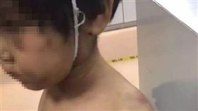 大陸,杭州,虐打,下體,菸疤,傷疤,家暴。(圖/翻攝自澎派新聞)