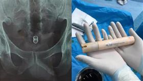 洗澡,跌倒,直腸,肛門,面霜棒,雲南,麗江,就醫,檢查　圖／翻攝自微博