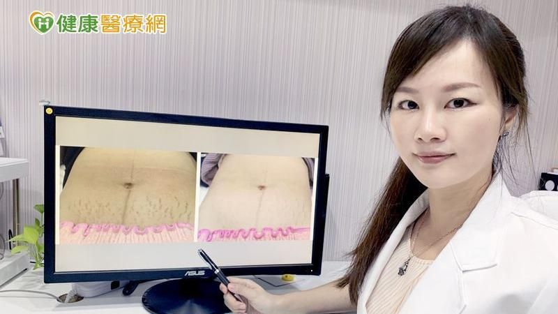愛的印記讓妳沒自信？　醫美讓它退場