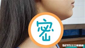  一名28歲的李小姐已經與右頸的甲狀腺良性腫瘤和平共處長達10年。（圖非新聞當事人／馬偕醫院提供）