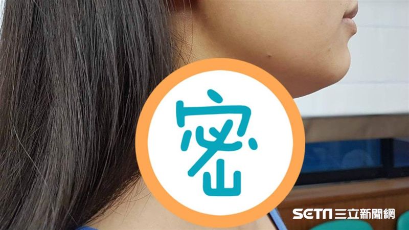 「脖凸慘歪」不敢拍婚紗　竟腫瘤惹禍