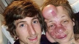 美國,氣球,血管瘤,腦動靜脈血管畸形,AVM。(圖/翻攝自IG)