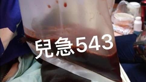 2歲男童狂吐3袋鮮血！醫師曝病因