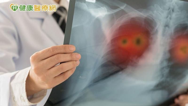 阿嬤晚期肺癌怕打針　口服化療撐2年