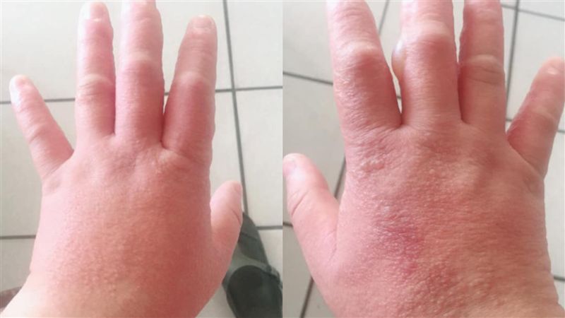 新竹妹手狂冒水泡　他曝：一抓就流膿