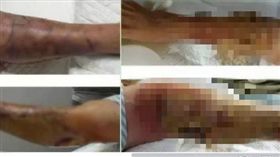 創傷弧菌,生蠔,截肢（圖／翻攝自新浪新聞）