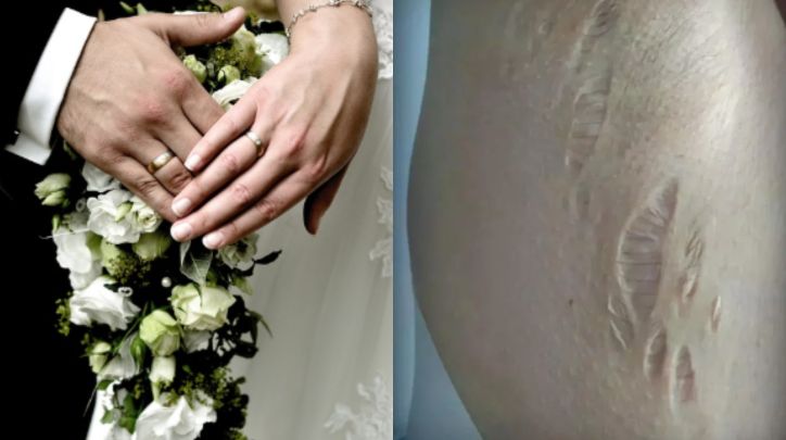 女醫新婚皮膚崩裂！夫一句露恐怖馬腳
