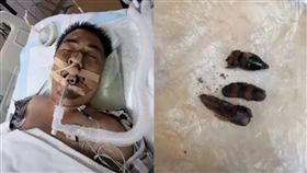 大陸,貴州,斑螫,劇毒,甲蟲,暈倒,昏迷,加護病房,偏方,洗澡,中醫,狂犬病 圖／翻攝自微博