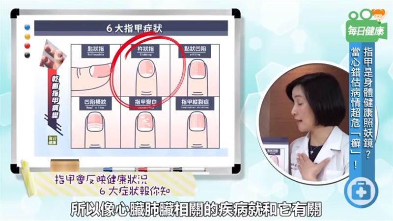 醫：常見6種指甲看身體健康！