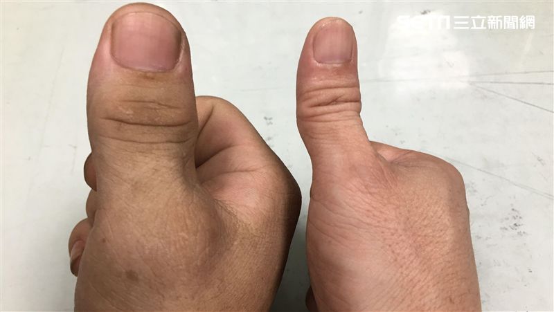 手指超粗竟是這病　就醫驚爆腦瘤恐瞎
