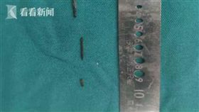 再不拔就癱瘓！8歲童脖子痛就醫　體內竟插「3根針」6年（圖／翻攝自微博）