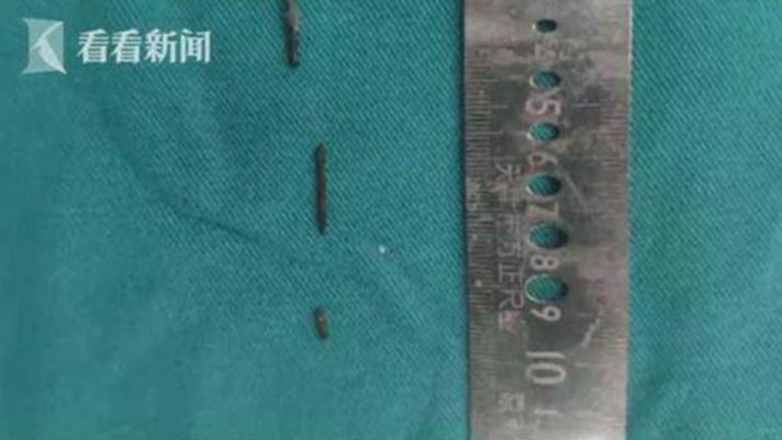 脖子痛就醫！男童體內竟插「3根針」