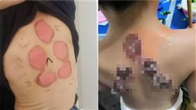 三伏貼,中國,燒傷,孩童（圖／翻攝自微博）