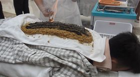 廣西壯醫「神龍灸」必須選用當地特產的「小黃薑末」作為基底，接著搭配艾灸，全程需要1小時。