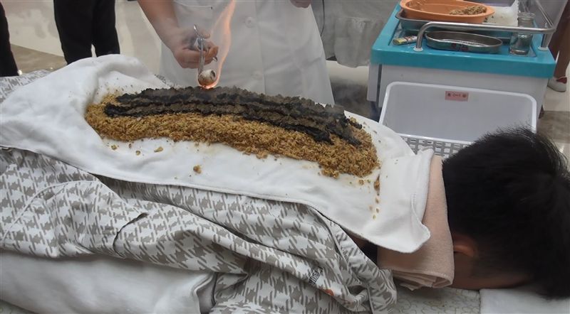 廣西力推壯族傳統醫學　神龍灸背上烤