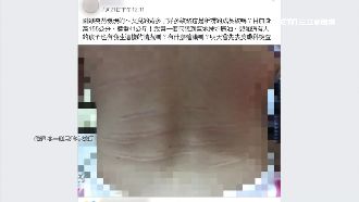 女兒背現「詭紋路」母傻眼！醫解答了