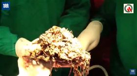 噁心慎入！肚內藏了200萬　26歲女怪病「狂吃金飾」（圖／翻攝自DailyMail YouTube）