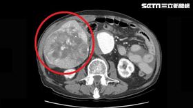 肝癌,中草藥,腫瘤,大千綜合醫院,肝膽腸胃科,林裕鈞,心肌梗塞