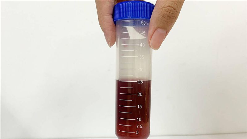 女腹痛找無病因　尿液變色才知罹罕病