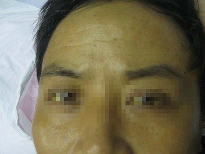 醫師表示，當腫瘤長在胰臟頭部，因膽管就在旁邊，很容易被壓到阻塞，因而產生黃疸。（示意圖／資料照）