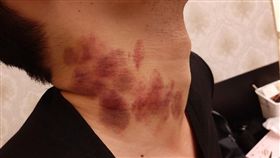 他炫耀脖子開「草莓園」！網勸快買保險（圖／翻攝自靠北女友）