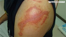 大千綜合醫院,皮膚,大千健康醫療體系,康平診所,皮膚科,蕭毓良,隱翅蟲,皮膚炎