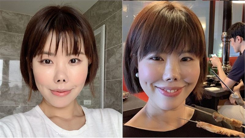 跌倒摔成朝天鼻　不取矽膠原因超傻眼