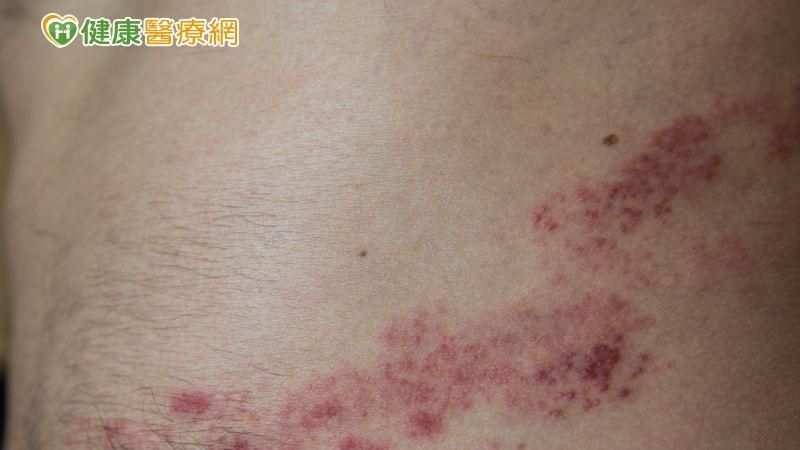 帶狀疱疹痛不欲生　老年族群疫苗預防
