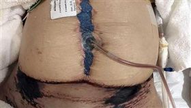 美國,安全帶,車禍,利劍,腹壁。(圖/翻攝自看看新聞)