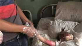 燙傷,大陸,浙江,玩耍,油鍋,皮膚,女童,漢堡店,鏈鎖店,休克　圖／翻攝自Pixabay