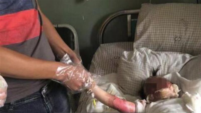 女童摔進油鍋　父母幫脫衣竟連皮扯下