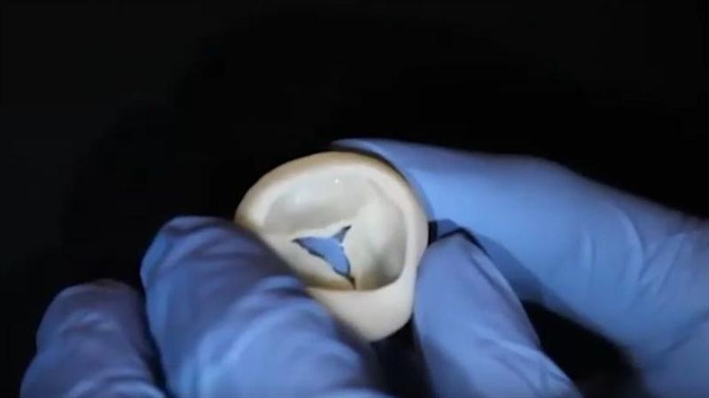 3D列印瓣膜問世　有望製出完整心臟