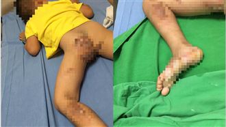 滑水設施沒降溫！童下半身遭燙傷潰爛