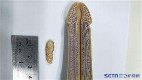 腎結石(侯鎮邦醫師)