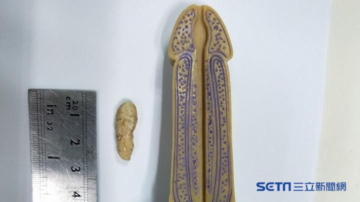 他活生生排出巨型腎結石　醫師也驚嘆
