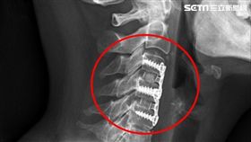 胸悶,胸痛,花蓮慈濟醫院,頸椎間盤,軟骨,脊椎神經,脊椎微創外科,洪祥益
圖／花蓮慈濟醫院